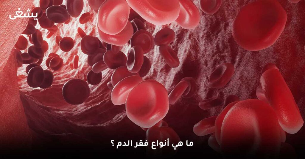 ما هي أنواع فقر الدم ؟