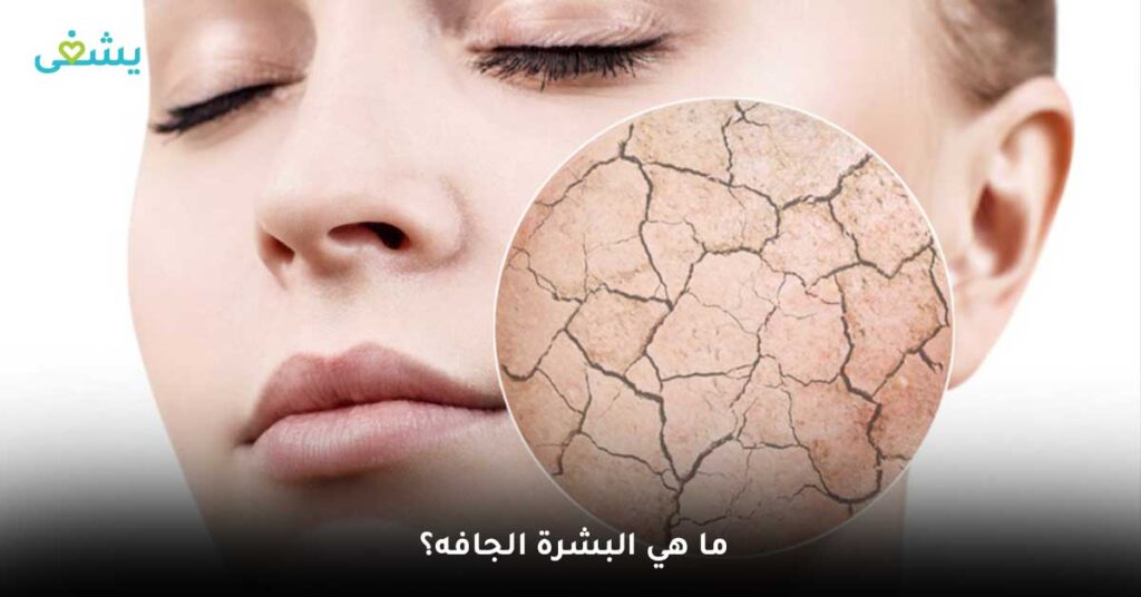 ما هي البشرة الجافة؟