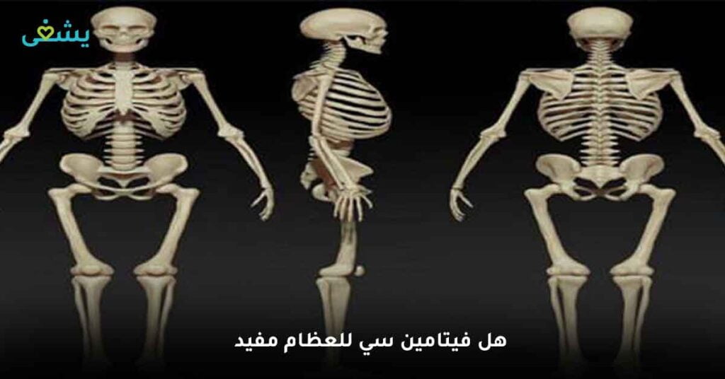 هل فيتامين سي للعظام مفيد ؟