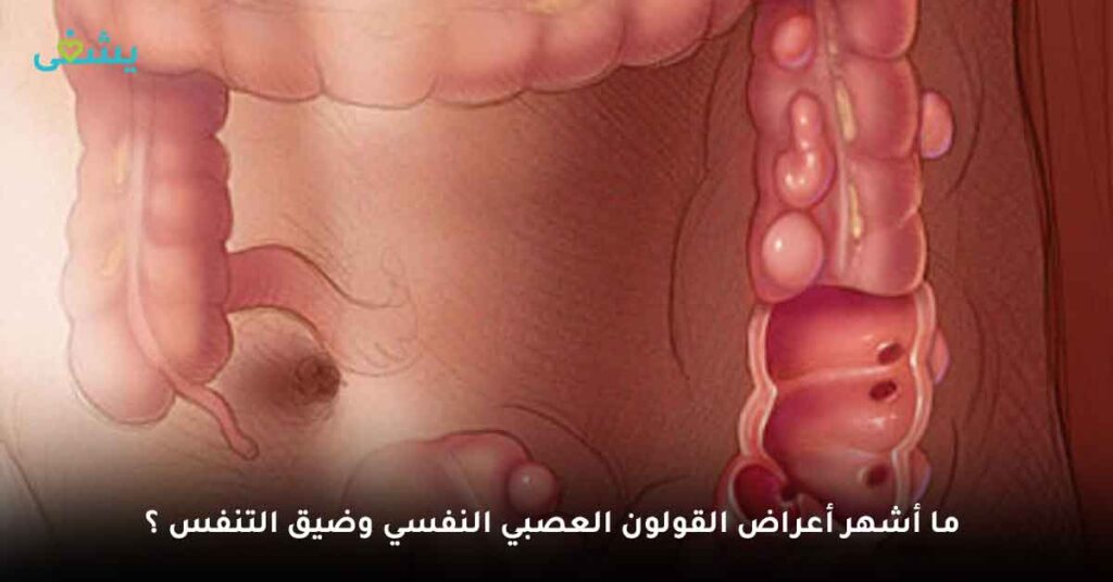 ما أشهر أعراض القولون العصبي النفسي وضيق التنفس ؟