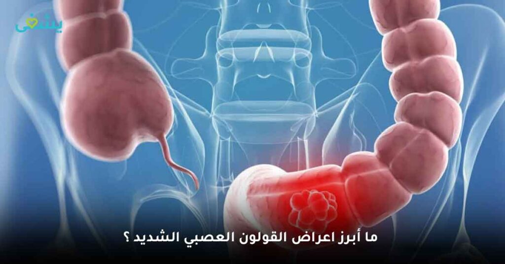 ما أبرز اعراض القولون العصبي الشديد ؟
