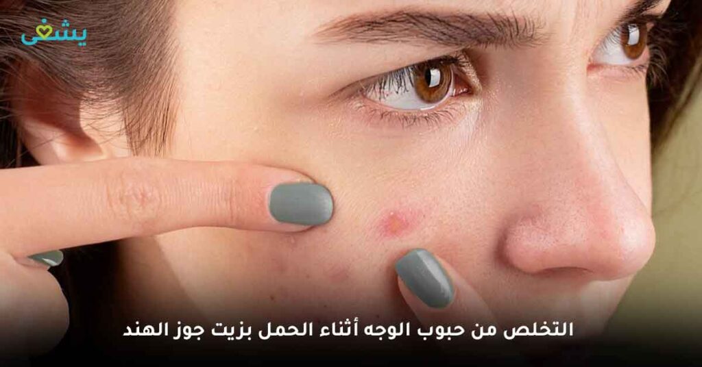 التخلص من حبوب الوجه أثناء الحمل بزيت جوز الهند