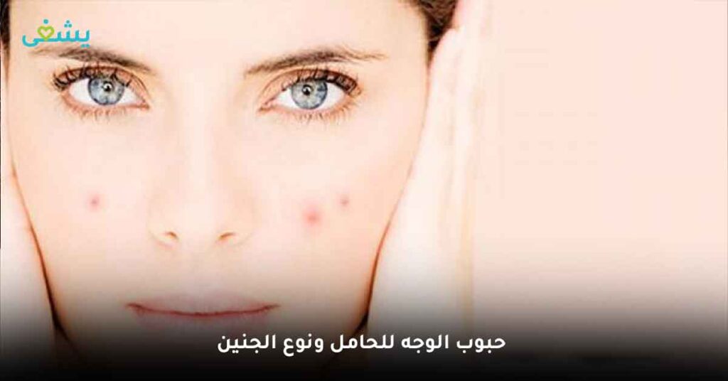 هل يوجد علاقة بين حبوب الوجه للحامل ونوع الجنين ؟