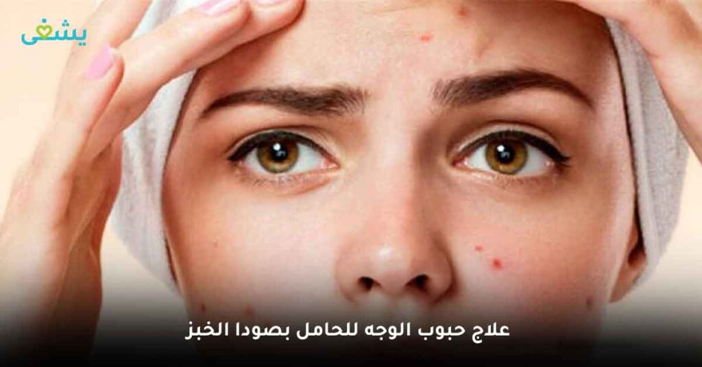 علاج حبوب الوجه للحامل بصودا الخبز