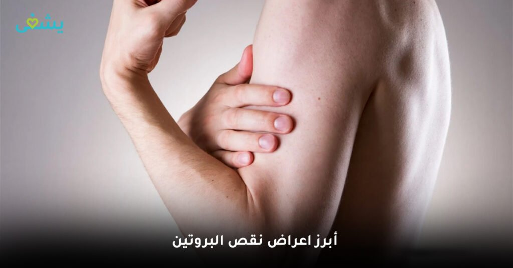 أبرز اعراض نقص البروتين
