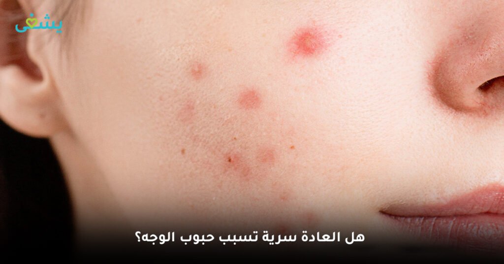 هل العادة سرية تسبب حبوب الوجه؟