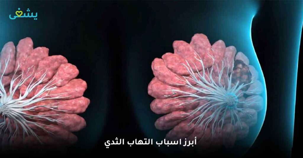 أبرز اسباب التهاب الثدي