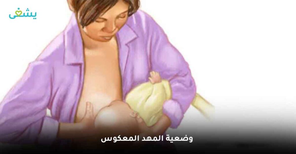 وضعية المهد المعكوس