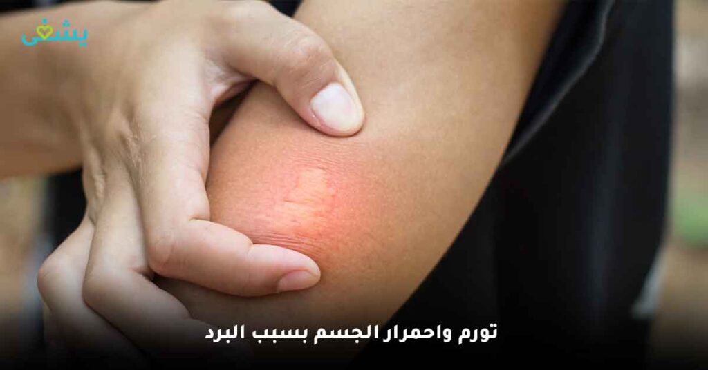 تورم-واحمرار-الجسم-بسبب-البرد