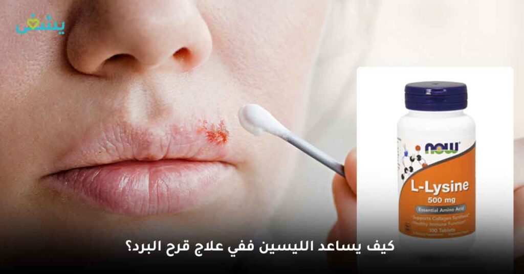 كيف يساعد الليسين في علاج قرح البرد؟