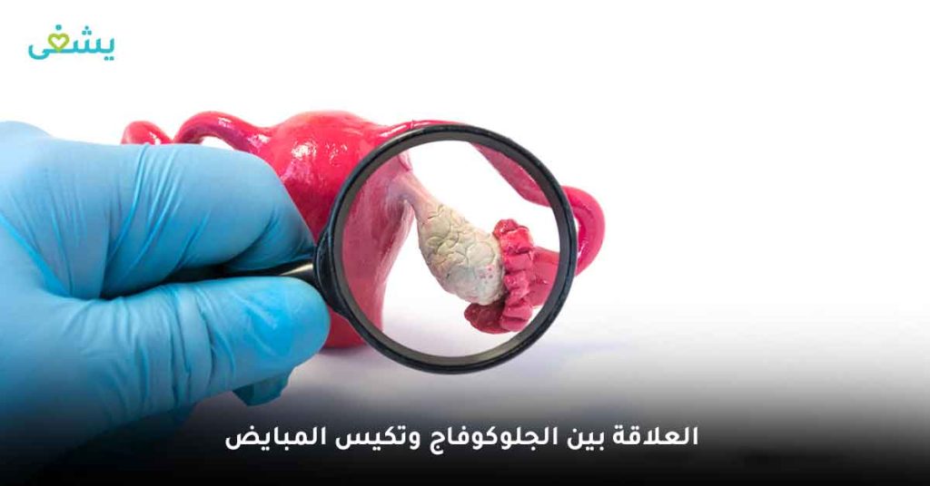 العلاقة بين الجلوكوفاج وتكيس المبايض