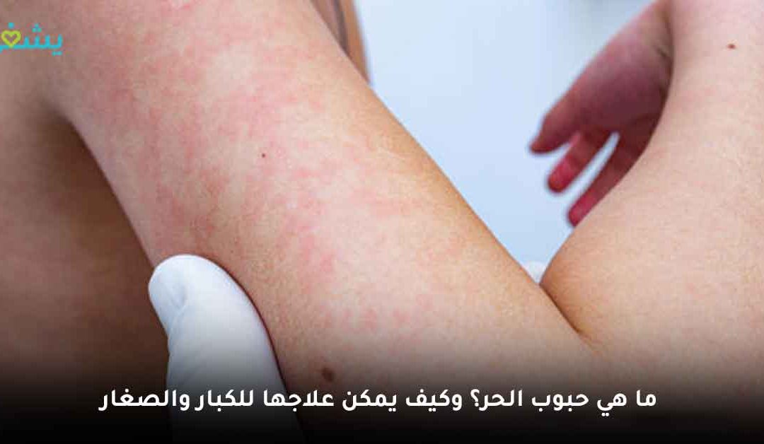 ما هي حبوب الحر؟ وهل ظهورها عند الأطفال دليل على حالة جلدية أخرى؟