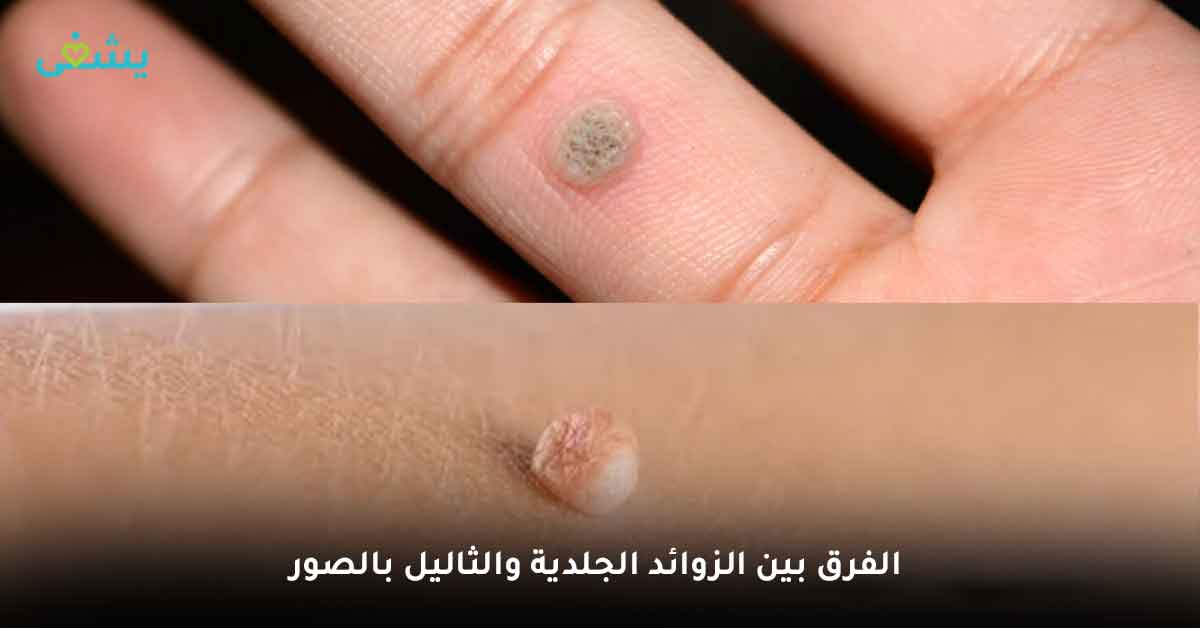 اكتشف الفرق بين الزوائد الجلدية والثاليل بالصور الآن 