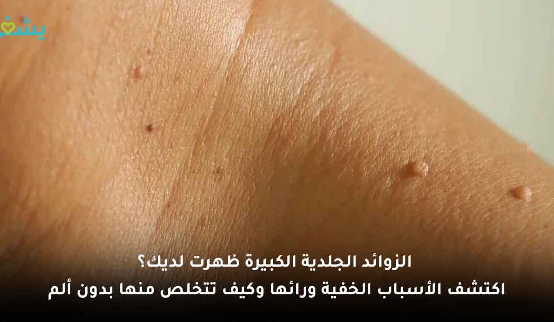 هل يمكن التخلص من الزوائد الجلدية بالكي أو الليزر؟ وهل تستدعي زيارة الطبيب فورًا؟