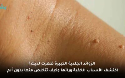 هل يمكن التخلص من الزوائد الجلدية بالكي أو الليزر؟ وهل تستدعي زيارة الطبيب فورًا؟
