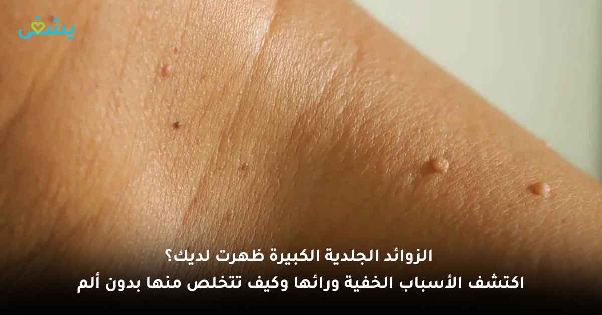 الزوائد الجلدية الكبيرة ظهرت لديك؟ اكتشف الأسباب الخفية ورائها وكيف تتخلص منها بدون ألم