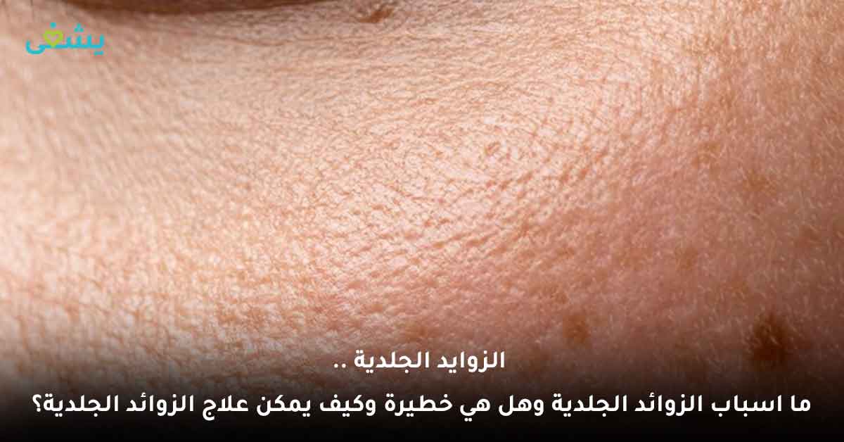 الزوايد الجلدية | ما اسباب الزوائد الجلدية وهل هي خطيرة وكيف يمكن علاج الزوائد الجلدية؟